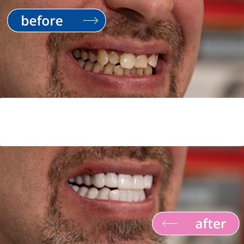 لمینت دندان دو فک مدل TruSmile به همراه نوار چسب سفیدکننده دندان